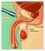 Penisvergrößerung Schaubild